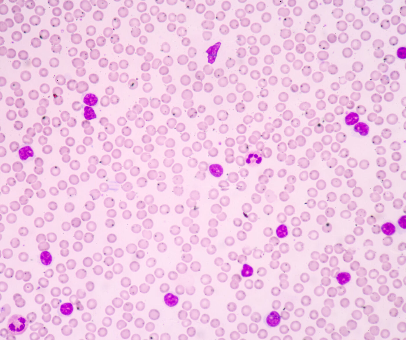 leukemia-progression-mapped-by-new-multi-omics-tool,-got-multi