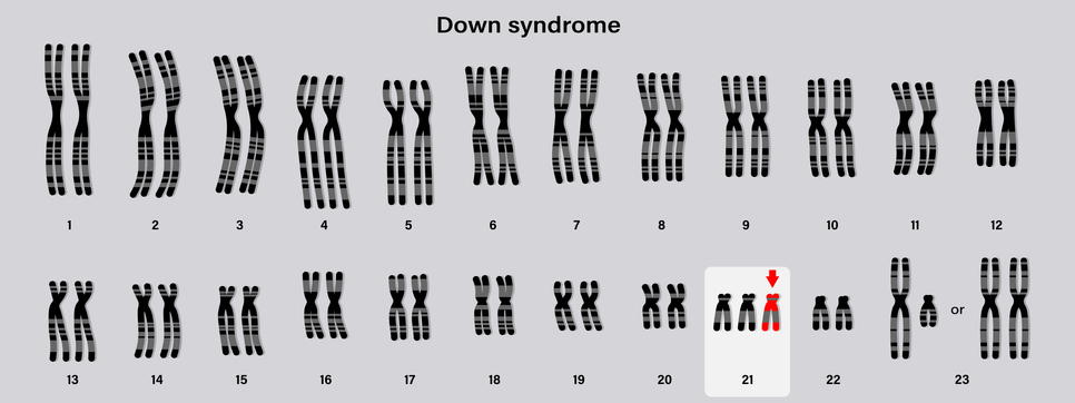 missing-molecule-may-explain-down-syndrome