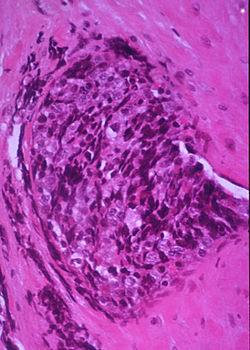 kinase-inhibitor-shows-promise-in-children-with-ewing-sarcoma