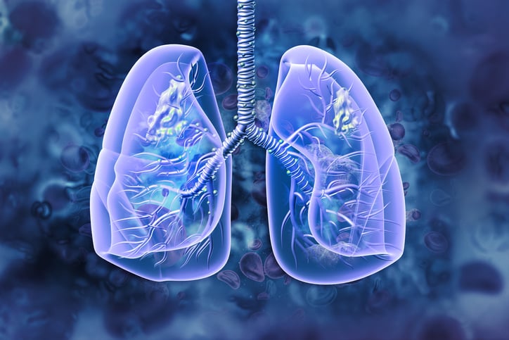 icecure’s-cryoablation-treatment-may-extend-survival-in-some-lung-cancer-patients,-study-finds