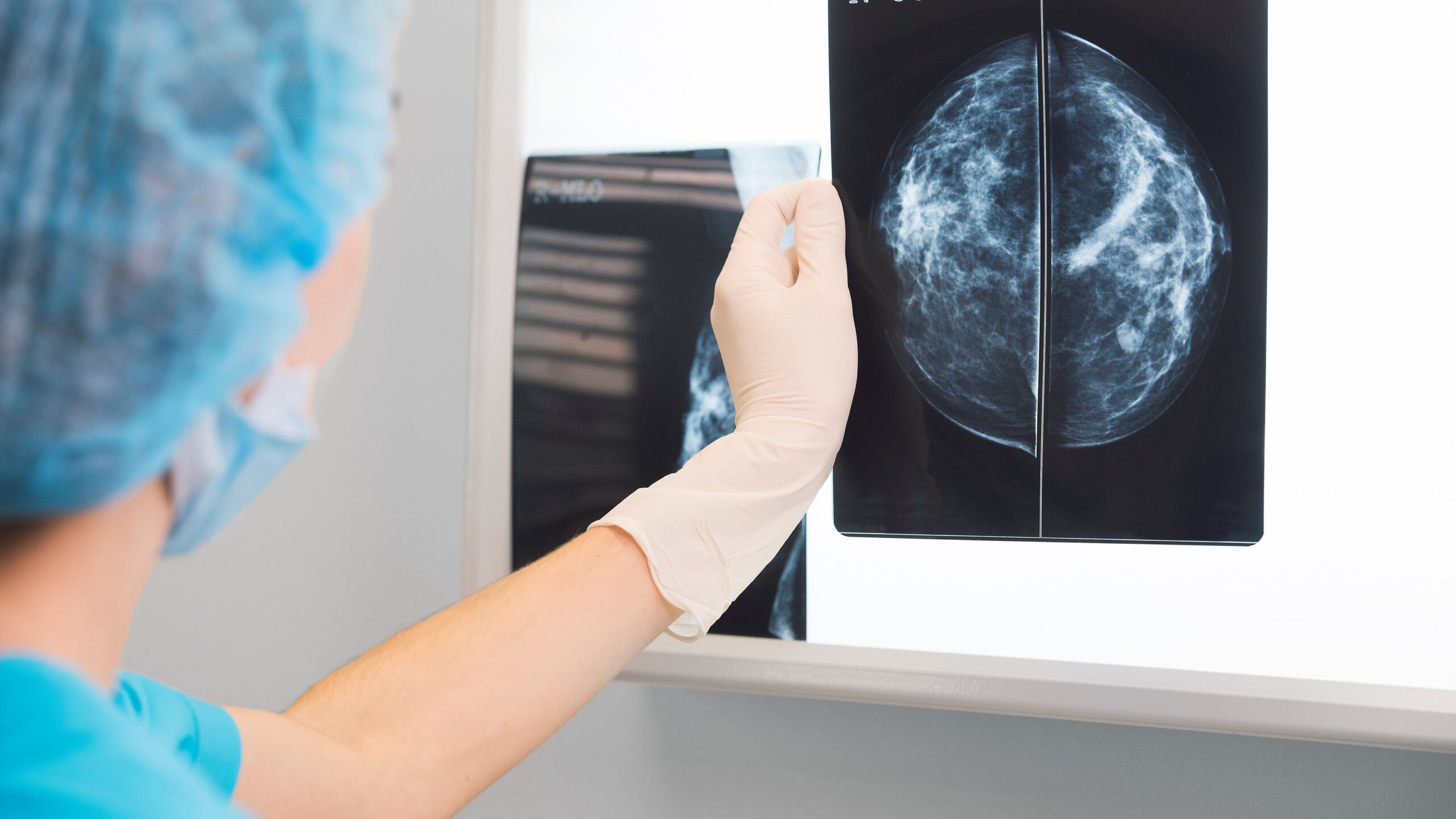 hologic-mammography-studies-show-promise-of-ai-in-breast-cancer-detection