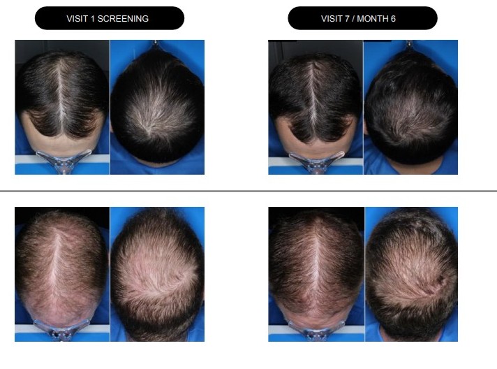 stockwatch:-cosmo-surges-40%-on-baldness-candidate’s-phase-iii-data